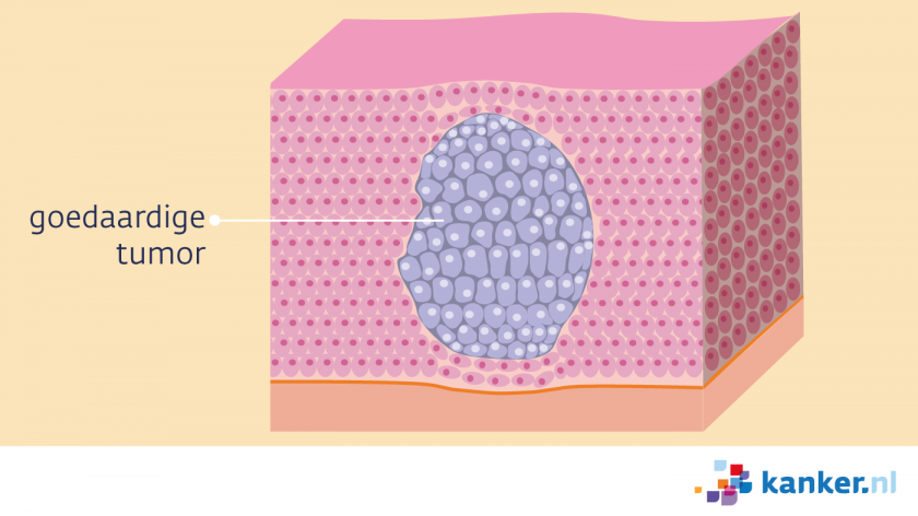 Goedaardige en kwaadaardige tumoren